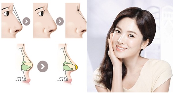 Phẫu thuật nâng mũi phương pháp đơn giản để sở hữu mũi tỷ lệ vàng