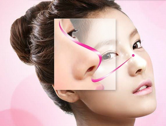 Kết quả nâng mũi S line duy trì được bao lâu? - nangmuislinedep.com.vn
