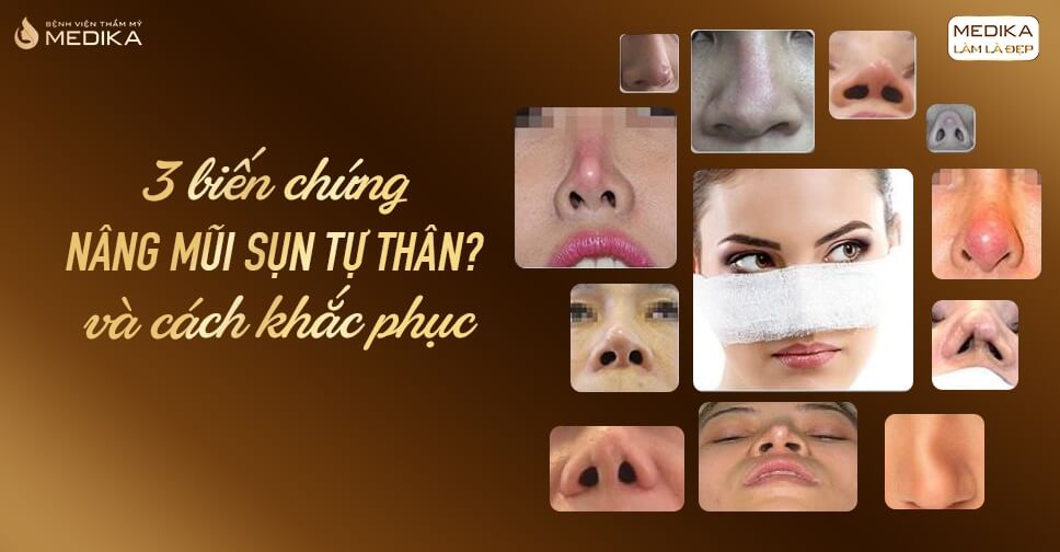 3 biến chứng nâng mũi sụn tự thân và cách khắc phục - Nangmuislinedep.com.vn