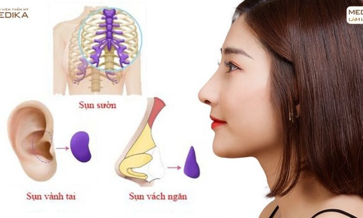 Những loại sụn chuyên gia khuyên dùng nâng mũi sụn tự thân - Nangmuislinedep.com.vn