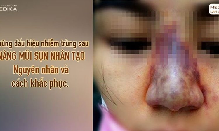 Những dấu hiệu nhiễm trùng sau nâng mũi sụn nhân tạo tại Nangmuislinedep.com.vn