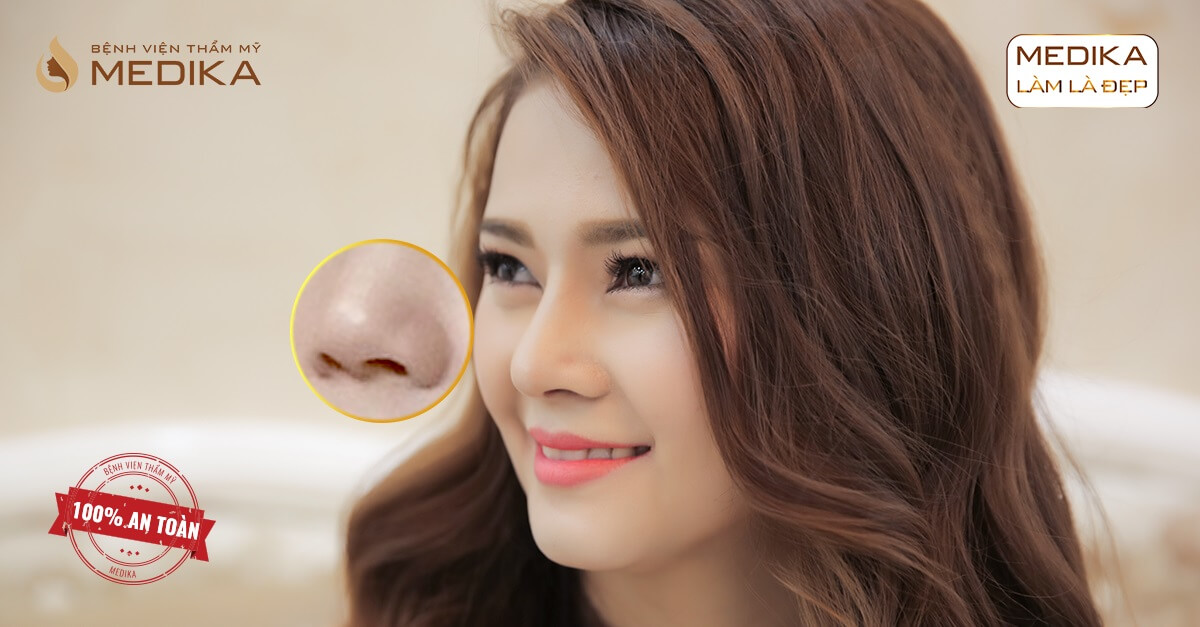 Thu gọn cánh mũi không cần phẫu thuật là đúng hay sai tại Nangmuislinedep.com.vn?