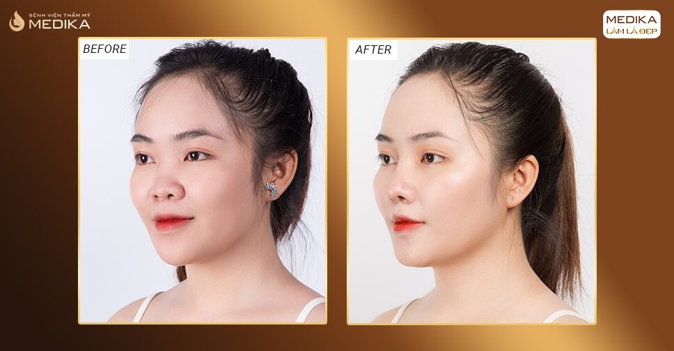 Phẫu thuật nâng mũi Surgiform vẻ đẹp tự nhiên - Ở Nangmuislinedep.com.vn